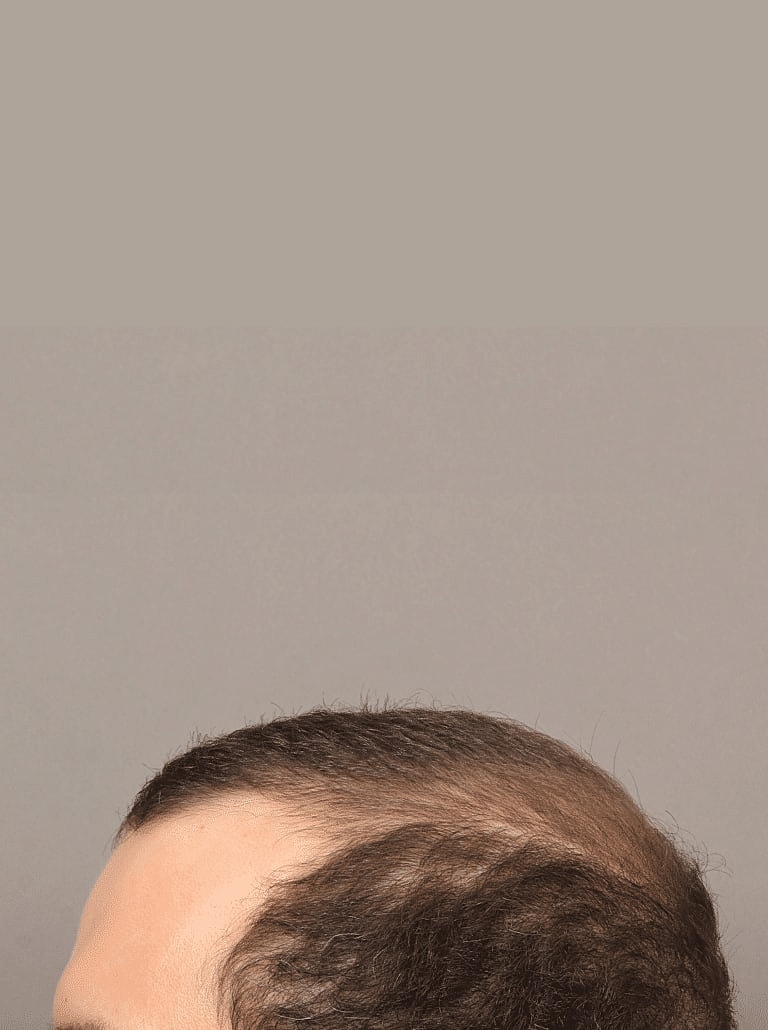 Hair Restoration Before & After