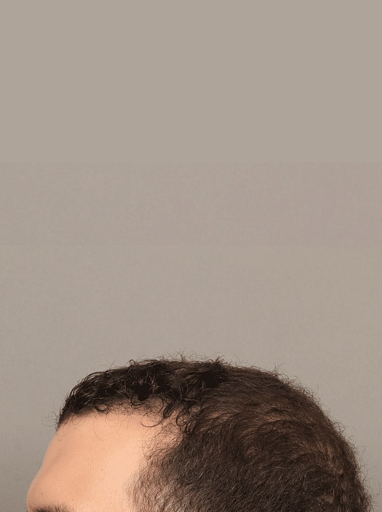 Hair Restoration Before & After