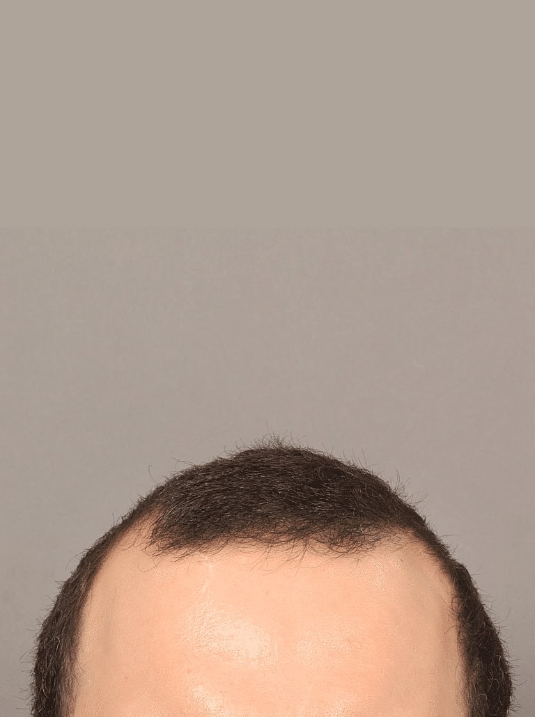 Hair Restoration Before & After