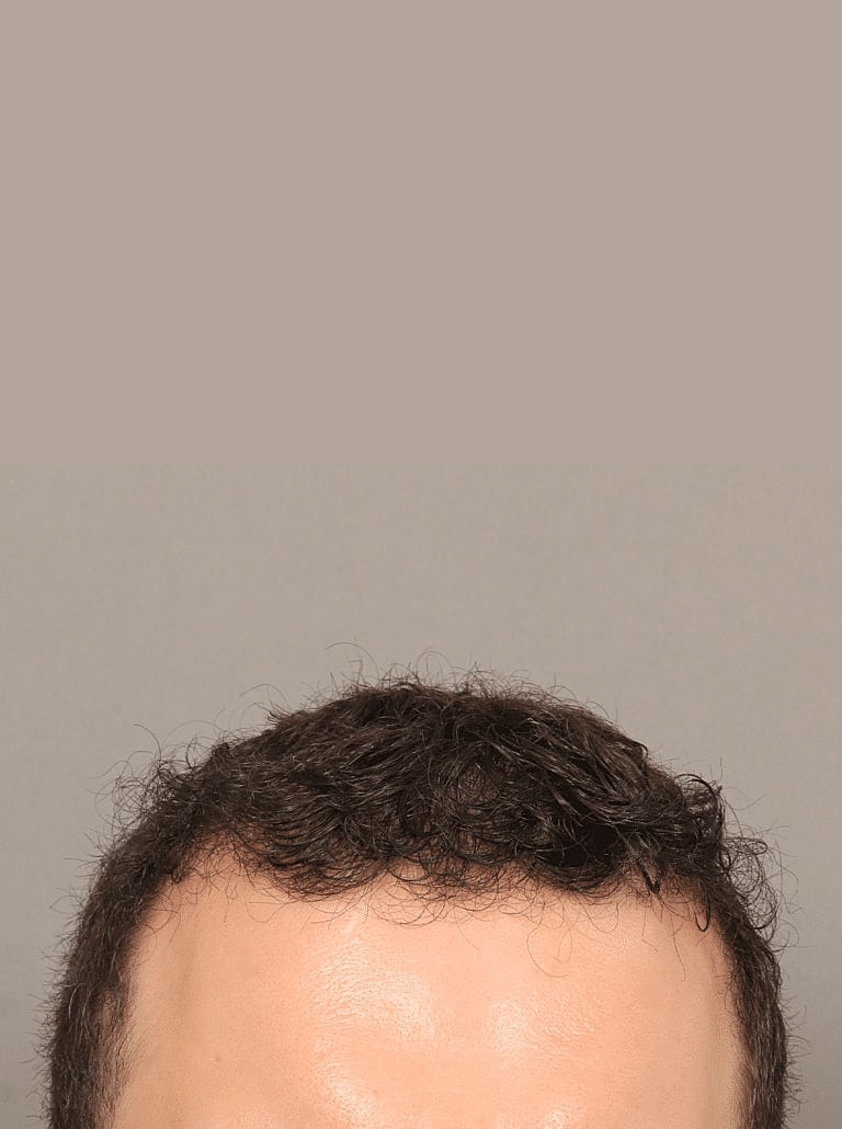 Hair Restoration Before & After