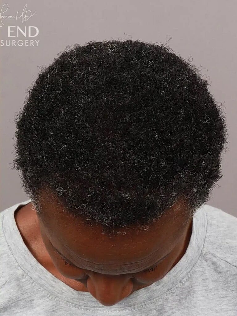 Hair Restoration Before & After