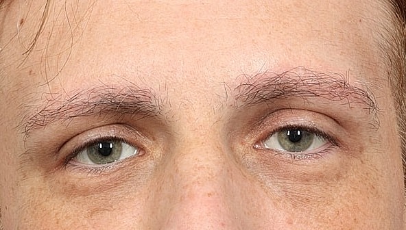 Hair Restoration Before & After