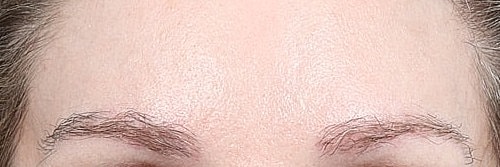 Hair Restoration Before & After
