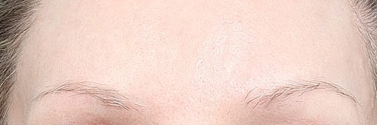 Hair Restoration Before & After