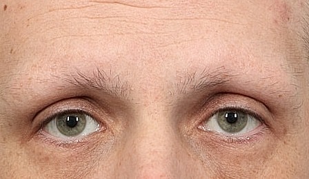 Hair Restoration Before & After