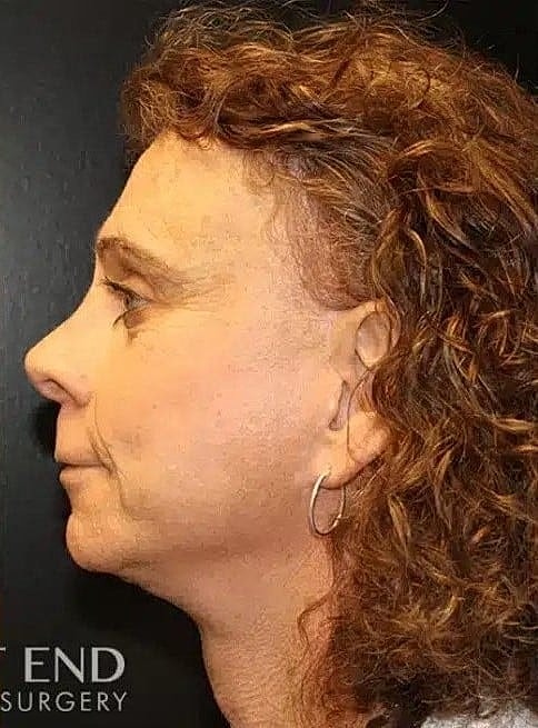 Tracheal Shave Before & After