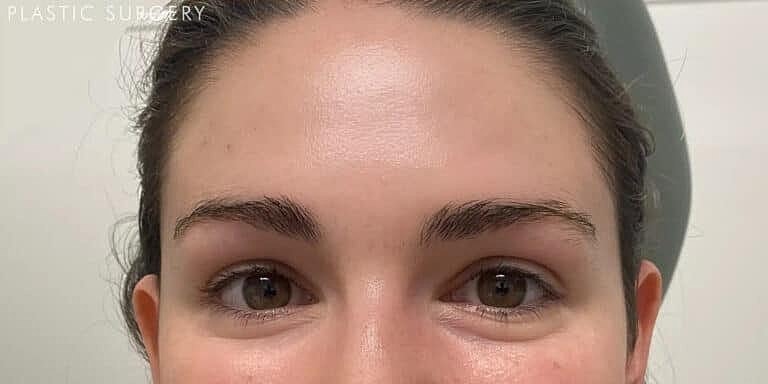 Xeomin Before & After