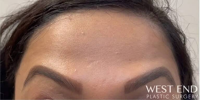 Xeomin Before & After