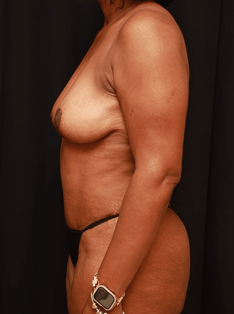 Tummy Tuck Before & After