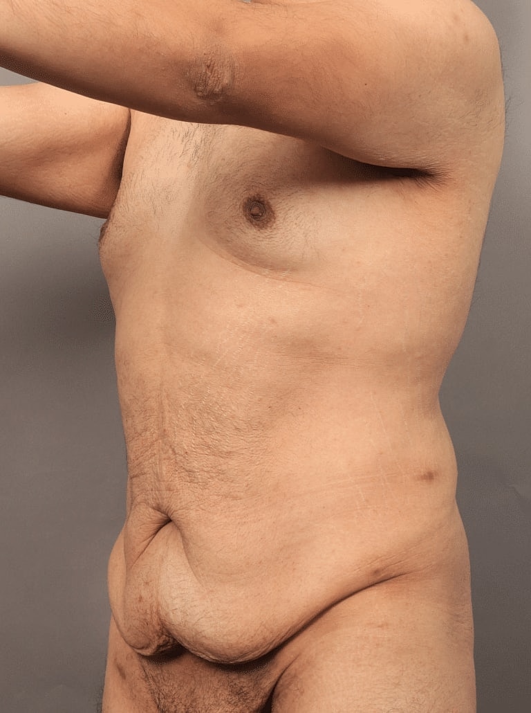 Tummy Tuck Before & After