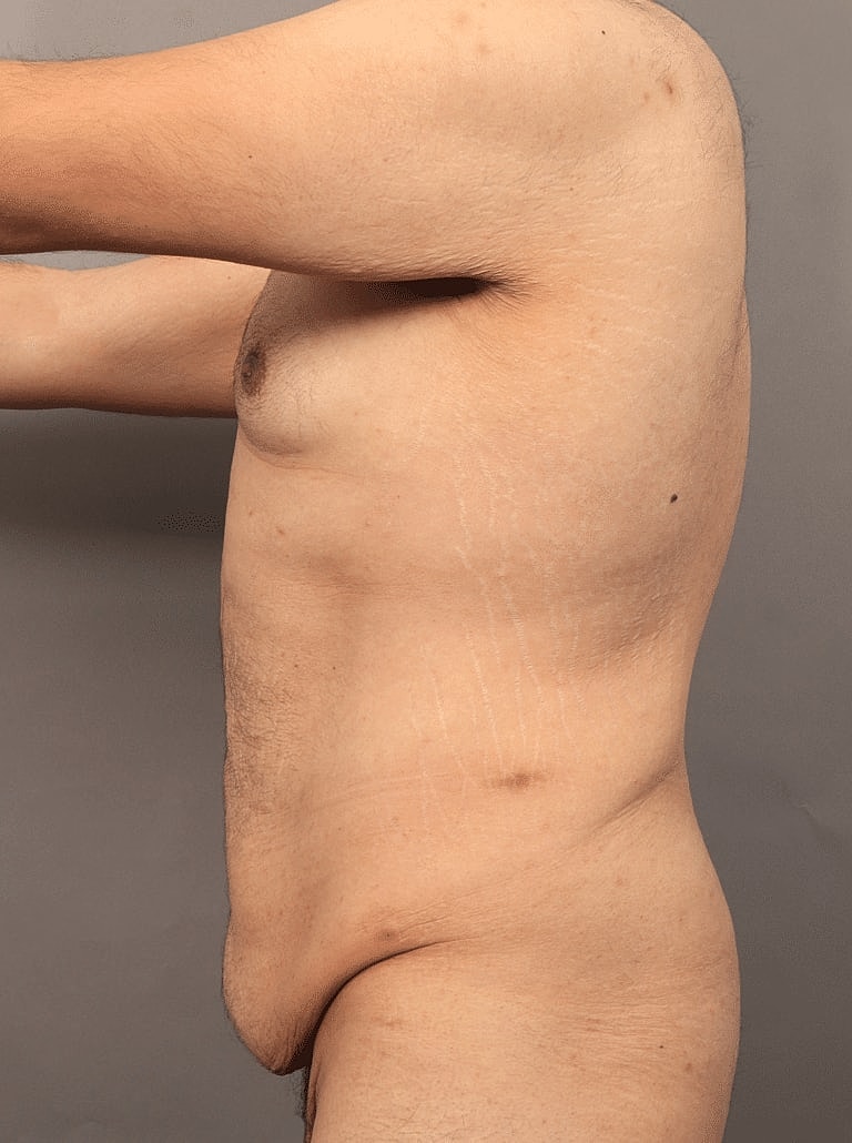 Tummy Tuck Before & After