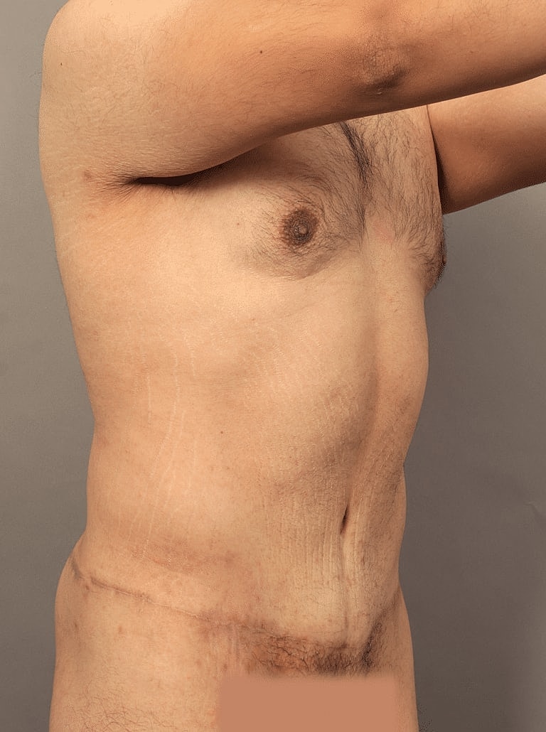 Tummy Tuck Before & After