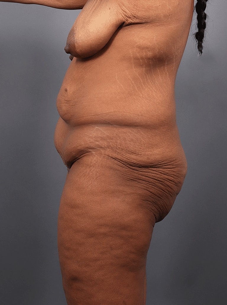 Tummy Tuck Before & After
