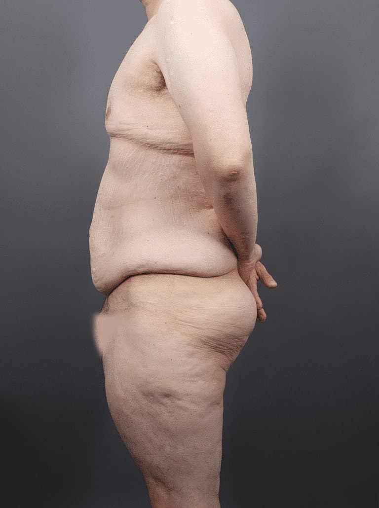 Tummy Tuck Before & After