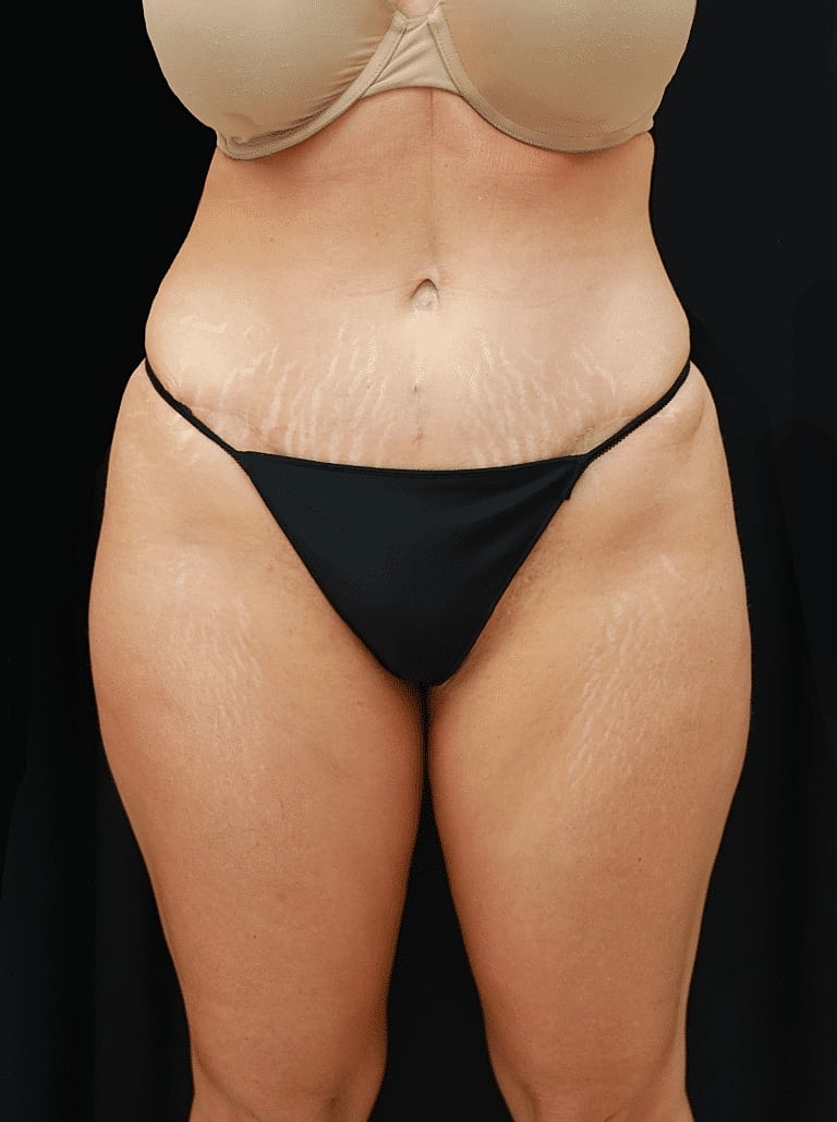 Tummy Tuck Before & After