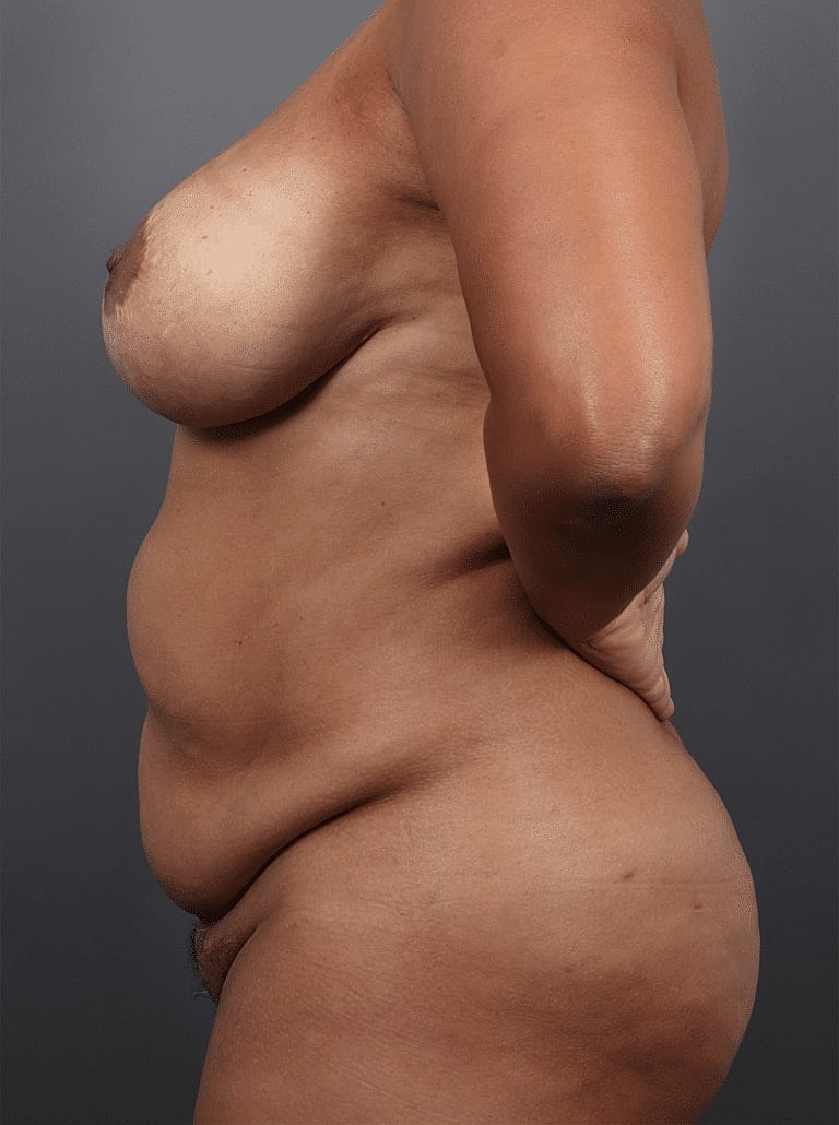 Tummy Tuck Before & After
