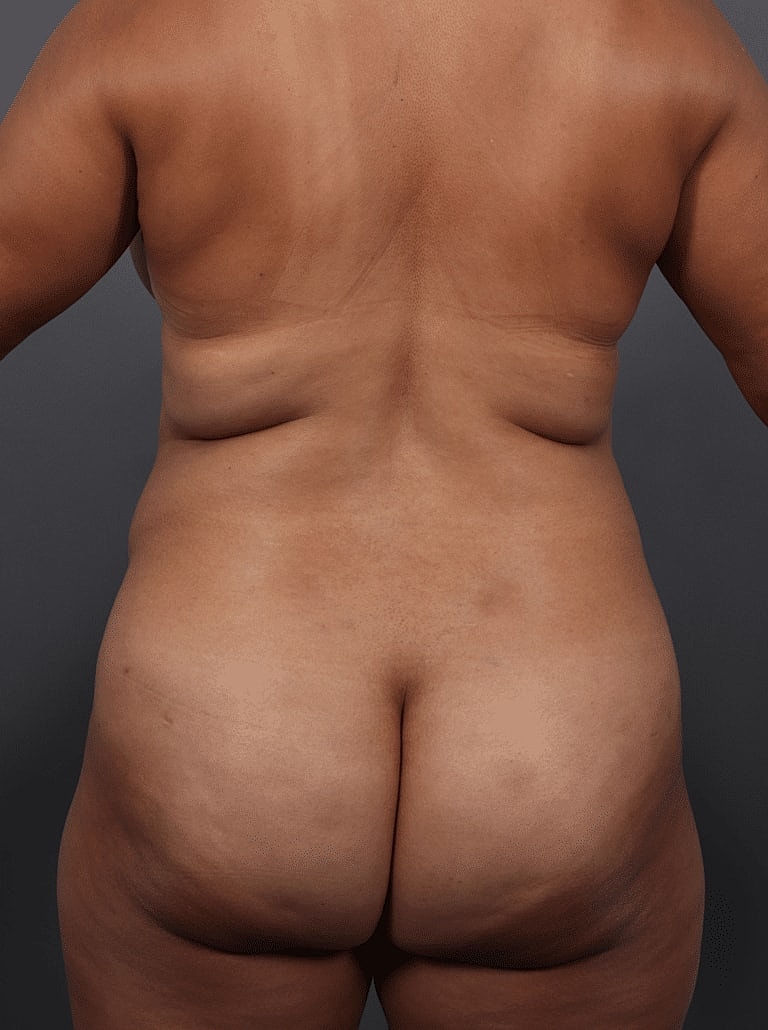 Tummy Tuck Before & After