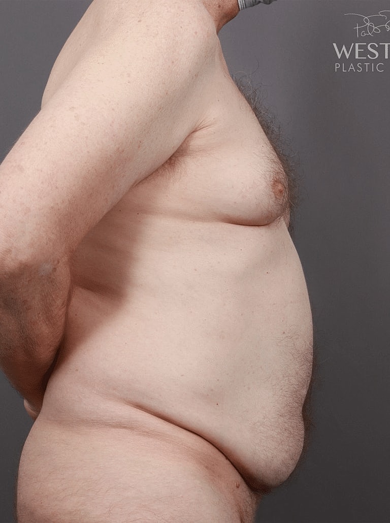 Tummy Tuck Before & After