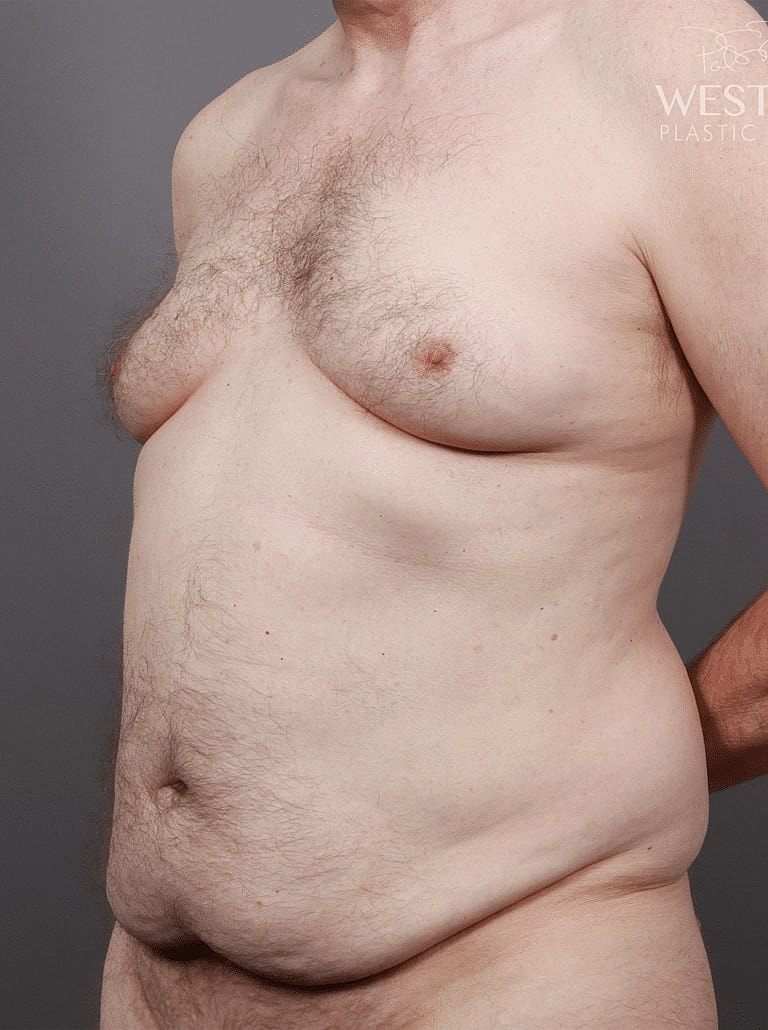 Tummy Tuck Before & After