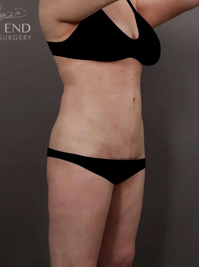 Tummy Tuck Before & After