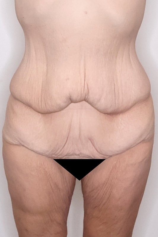 Tummy Tuck Before & After