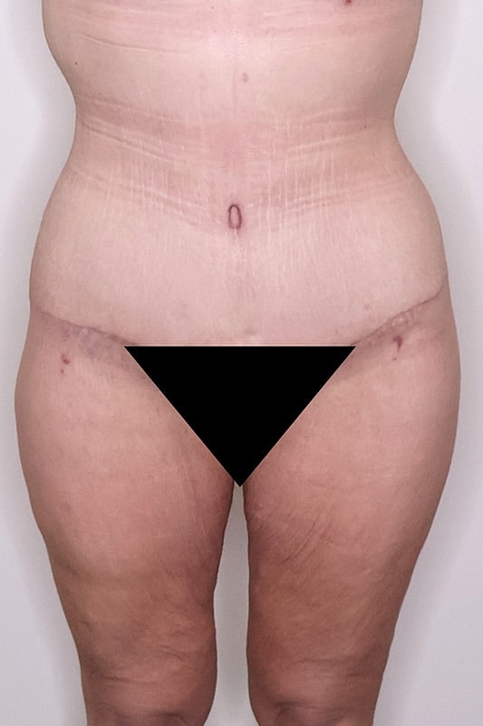 Tummy Tuck Before & After
