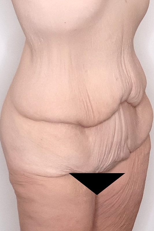 Tummy Tuck Before & After
