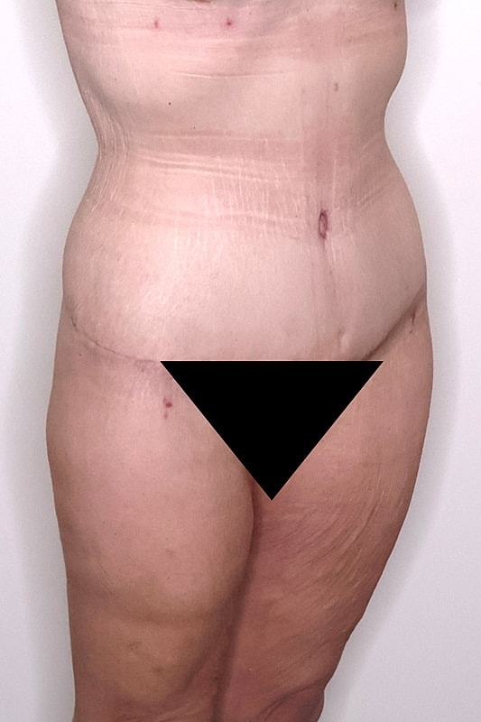 Tummy Tuck Before & After