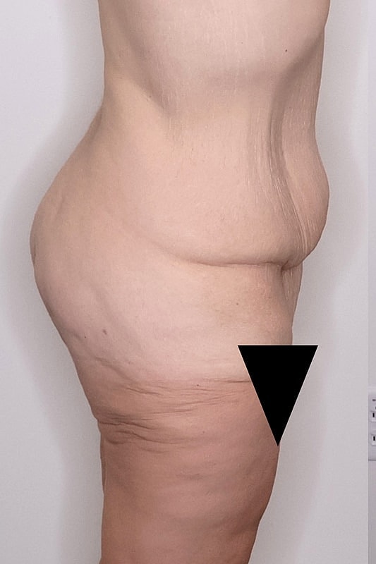 Tummy Tuck Before & After
