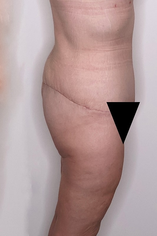 Tummy Tuck Before & After
