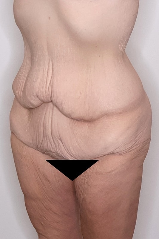 Tummy Tuck Before & After