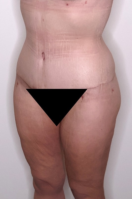 Tummy Tuck Before & After