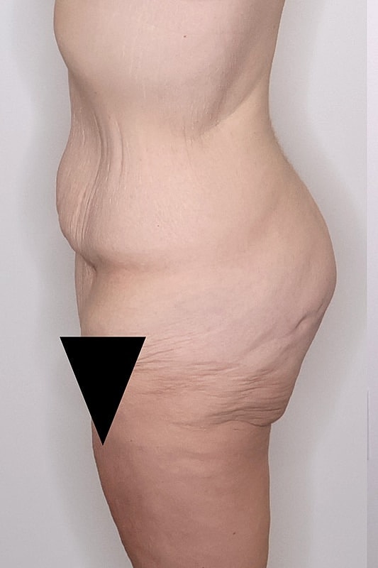 Tummy Tuck Before & After