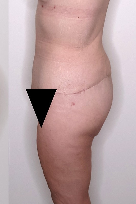Tummy Tuck Before & After