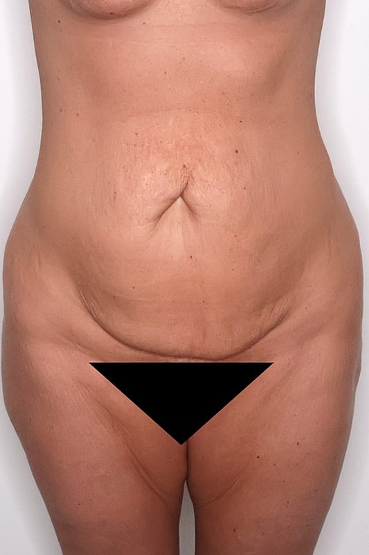 Tummy Tuck Before & After