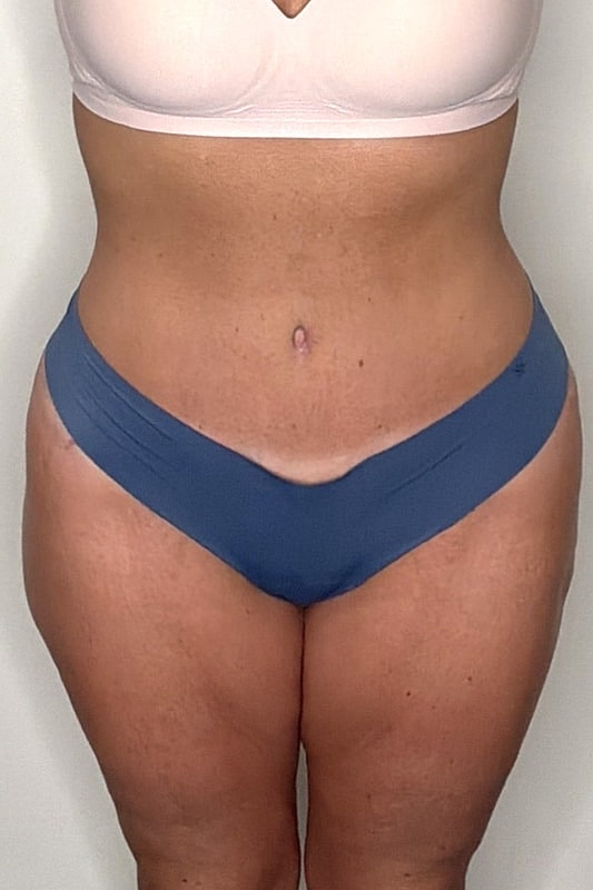Tummy Tuck Before & After
