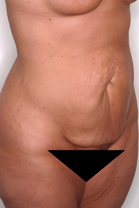 Tummy Tuck Before & After