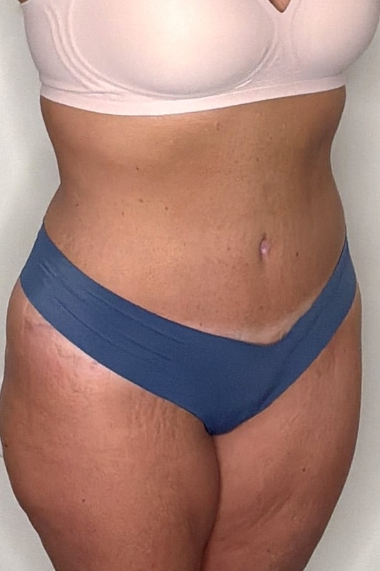 Tummy Tuck Before & After