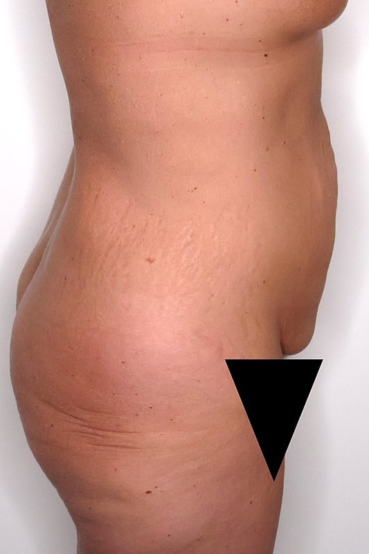 Tummy Tuck Before & After