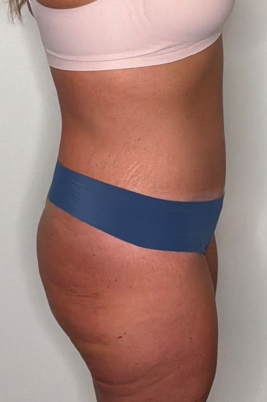 Tummy Tuck Before & After