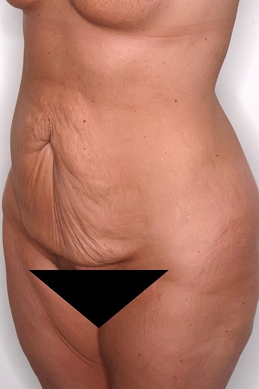 Tummy Tuck Before & After