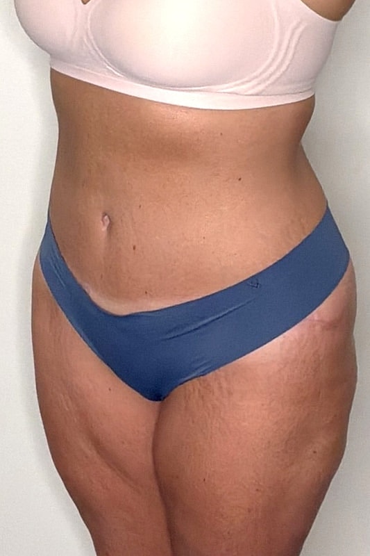 Tummy Tuck Before & After