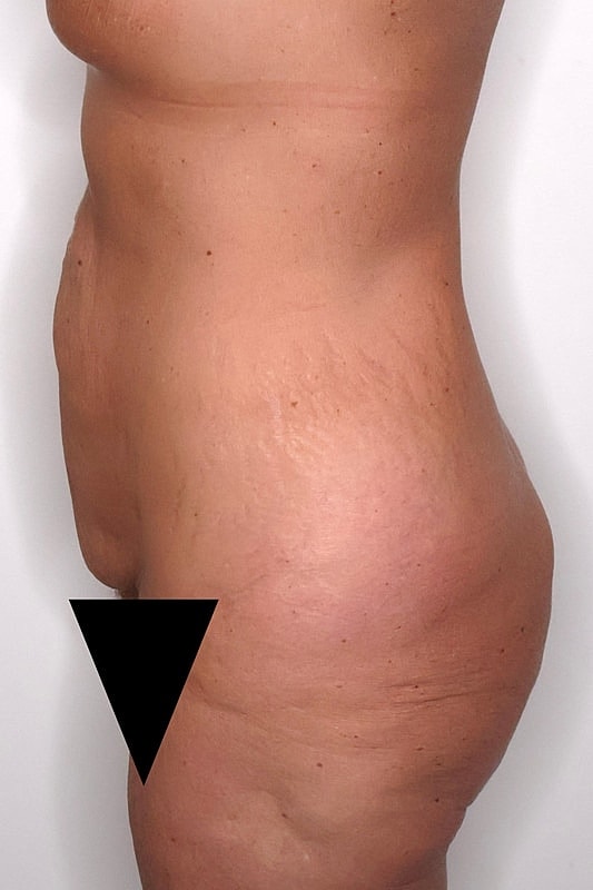 Tummy Tuck Before & After