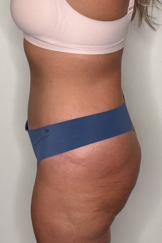 Tummy Tuck Before & After