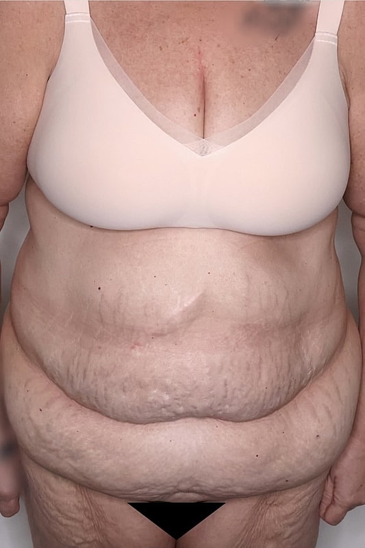 Tummy Tuck Before & After