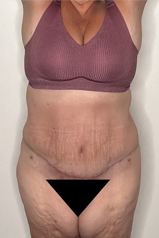 Tummy Tuck Before & After