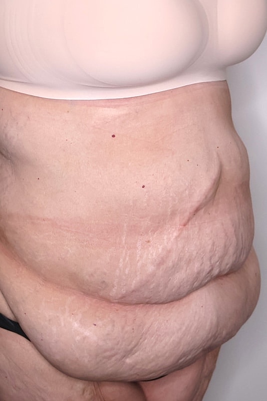 Tummy Tuck Before & After