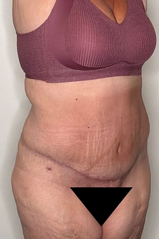 Tummy Tuck Before & After