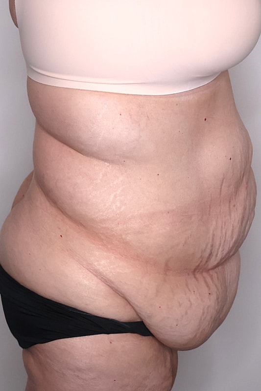 Tummy Tuck Before & After
