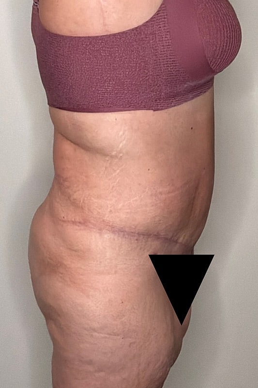 Tummy Tuck Before & After